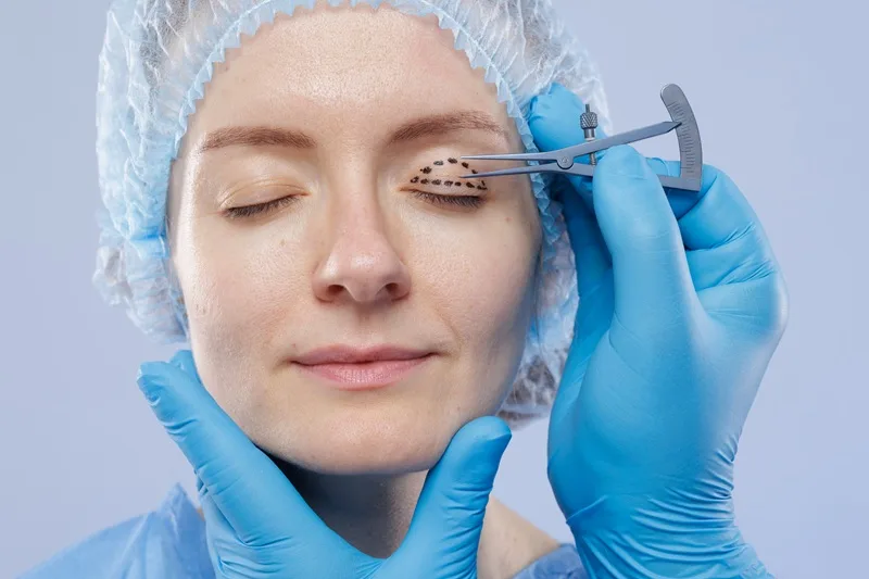Blefaroplastia