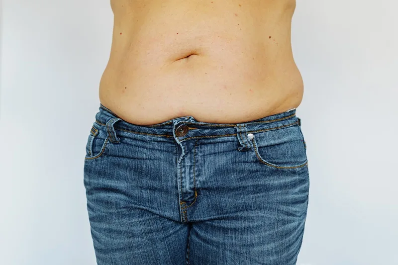 Diástasis abdominal en CDMX