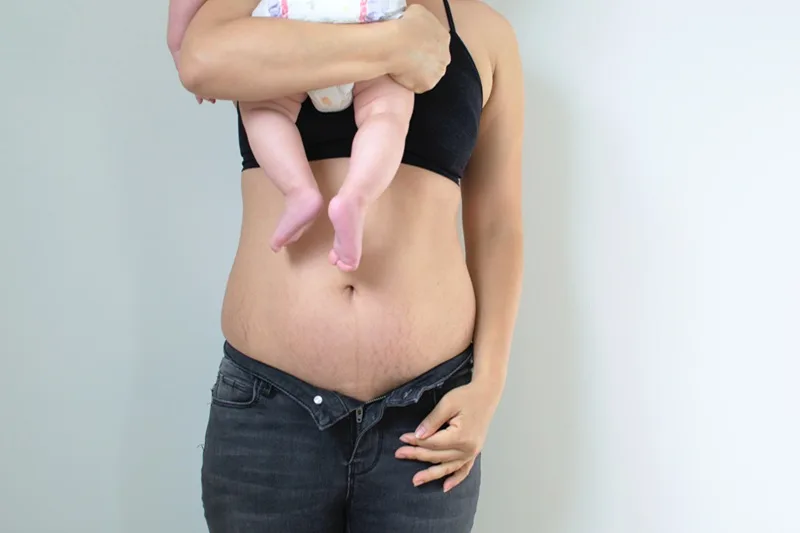 Cirugía postembarazo / Mommy Makeover